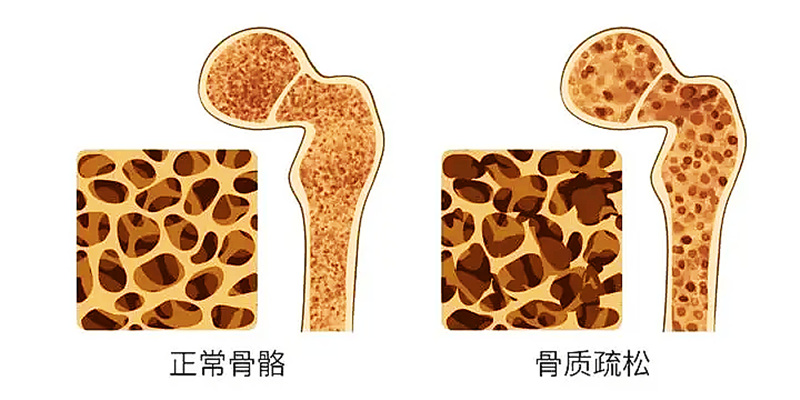 骨密度檢測