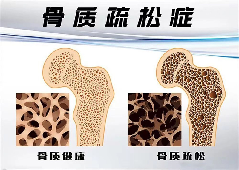 骨質(zhì)疏松防治秘籍